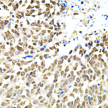Immunohistochemistry of paraffin-embedded human lung cancer using PNKP antibody  at dilution of 1:100 