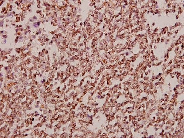 Immunohistochemistry (IHC) analyzes of TAF II p68 (N380) pAb in paraffin-embedded human tonsil carcinoma tissue at 1:50