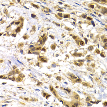 Immunohistochemistry of paraffin-embedded human breast cancer using MAGEA1 antibody at dilution of 1:200 (40x lens)