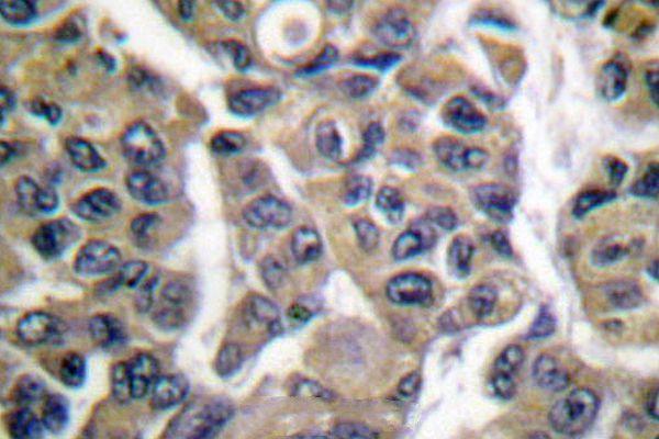 Immunohistochemistry (IHC) analyzes of MAGE-1/Tumor antigen MAGE-N (F293) pAb in paraffin-embedded human breast carcinoma tissue