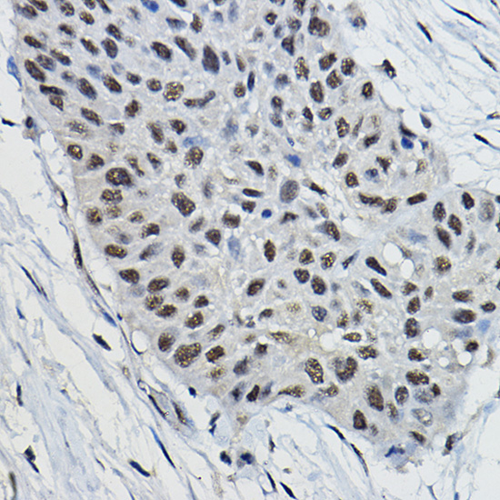 Immunohistochemistry of paraffin-embedded human lung cancer using BRAP Rabbit pAb  at dilution of 1:100 