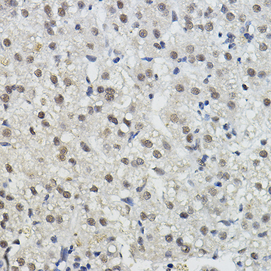 Immunohistochemistry of paraffin-embedded human liver cancer using BRAP Rabbit pAb  at dilution of 1:100 