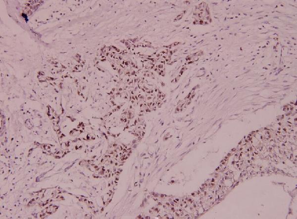 Immunohistochemistry (IHC) analyzes of MCM5 (F51) pAb in paraffin-embedded human breast carcinoma tissue at 1:100