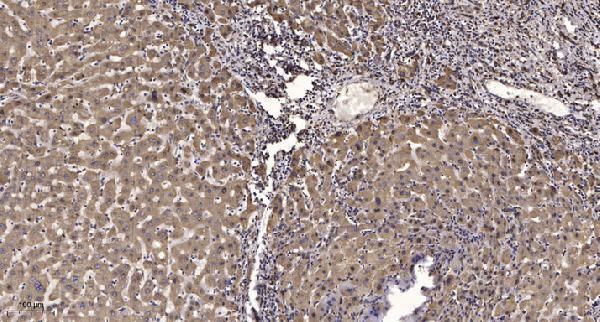 Immunohistochemical analysis of paraffin-embedded human liver cancer