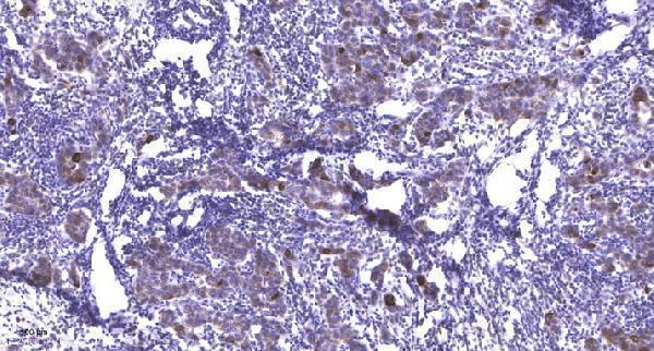 Immunohistochemical analysis of paraffin-embedded human Breast cancer