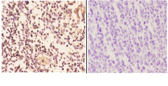 Immunohistochemistry (IHC) analyzes of Actinin-α2/3 (Q58) pAb in paraffin-embedded human tonsil carcinoma tissue at 1:50
