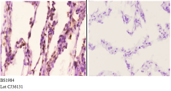 Immunohistochemistry (IHC) analyzes of Actinin-α2/3 (Q58) pAb in paraffin-embedded human lung carcinoma tissue at 1:50