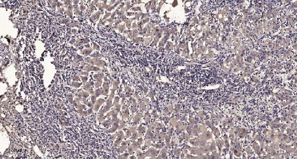 Immunohistochemical analysis of paraffin-embedded human liver cancer