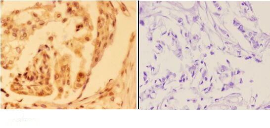 Immunohistochemistry (IHC) analyzes of AMPKβ1 (V175) pAb in paraffin-embedded human breast carcinoma tissue at 1:50,showing cytoplasm and nuclear staining