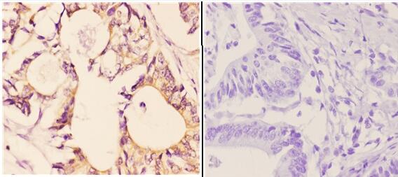 Immunohistochemistry (IHC) analyzes of p-AMPKβ1 (S181) pAb in paraffin-embedded human colon carcinoma tissue at 1:50,showing cytoplasmic and nuclear staining
