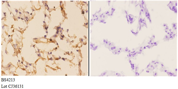 Immunohistochemistry (IHC) analyzes of p-AMPKβ1 (S181) pAb in paraffin-embedded human lung carcinoma tissue at 1:50,showing cytoplasmic and nuclear staining