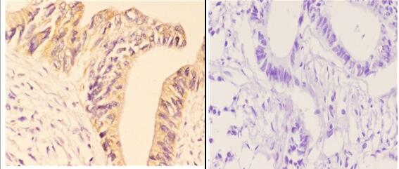 Immunohistochemistry (IHC) analyzes of p-AMPKβ1 (S181) pAb in paraffin-embedded human rectum carcinoma tissue at 1:50,showing cytoplasmic and nuclear staining