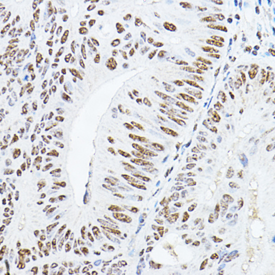 Immunohistochemistry of paraffin-embedded human colon carcinoma using YEATS4 Rabbit pAb  at dilution of 1:100 
