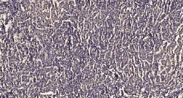 Immunohistochemical analysis of paraffin-embedded human meningioma