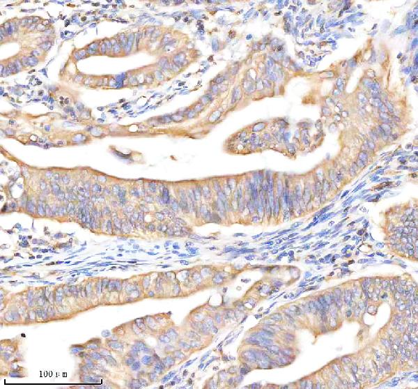 Figure 2. IHC analysis of BAP31/BCAP31 using anti-BAP31/BCAP31 antibody (A03767-4). BAP31/BCAP31 was detected in a paraffin-embedded section of human colon cancer tissue. Heat mediated antigen retrieval was performed in EDTA buffer (pH 8.0, epitope retrieval solution). The tissue section was blocked with 10% goat serum. The tissue section was then incubated with 2 microg/ml rabbit anti-BAP31/BCAP31 Antibody (A03767-4) overnight at 4°C. Peroxidase Conjugated Goat Anti-rabbit IgG was used as secondary antibody and incubated for 30 minutes at 37°C. The tissue section was developed using HRP Conjugated Rabbit IgG Super Vision Assay Kit (Catalog # SV0002) with DAB as the chromogen. Figure 2. IHC analysis of BAP31/BCAP31 using anti-BAP31/BCAP31 antibody (A03767-4). BAP31/BCAP31 was detected in a paraffin-embedded section of human colon cancer tissue. Heat mediated antigen retrieval was performed in EDTA buffer (pH 8.0, epitope retrieval solution). The tissue section was blocked with 10% goat serum. The tissue section was then incubated with 2 microg/ml rabbit anti-BAP31/BCAP31 Antibody (A03767-4) overnight at 4°C. Peroxidase Conjugated Goat Anti-rabbit IgG was used as secondary antibody and incubated for 30 minutes at 37°C. The tissue section was developed using HRP Conjugated Rabbit IgG Super Vision Assay Kit (Catalog # SV0002) with DAB as the chromogen.