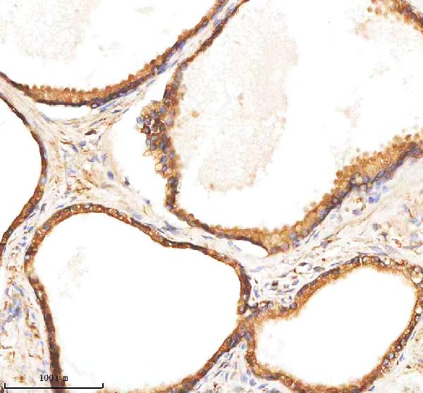 Figure 6. IHC analysis of BAP31/BCAP31 using anti-BAP31/BCAP31 antibody (A03767-4). BAP31/BCAP31 was detected in a paraffin-embedded section of human thyroid cancer tissue. Heat mediated antigen retrieval was performed in EDTA buffer (pH 8.0, epitope retrieval solution). The tissue section was blocked with 10% goat serum. The tissue section was then incubated with 2 microg/ml rabbit anti-BAP31/BCAP31 Antibody (A03767-4) overnight at 4°C. Peroxidase Conjugated Goat Anti-rabbit IgG was used as secondary antibody and incubated for 30 minutes at 37°C. The tissue section was developed using HRP Conjugated Rabbit IgG Super Vision Assay Kit (Catalog # SV0002) with DAB as the chromogen. Figure 6. IHC analysis of BAP31/BCAP31 using anti-BAP31/BCAP31 antibody (A03767-4). BAP31/BCAP31 was detected in a paraffin-embedded section of human thyroid cancer tissue. Heat mediated antigen retrieval was performed in EDTA buffer (pH 8.0, epitope retrieval solution). The tissue section was blocked with 10% goat serum. The tissue section was then incubated with 2 microg/ml rabbit anti-BAP31/BCAP31 Antibody (A03767-4) overnight at 4°C. Peroxidase Conjugated Goat Anti-rabbit IgG was used as secondary antibody and incubated for 30 minutes at 37°C. The tissue section was developed using HRP Conjugated Rabbit IgG Super Vision Assay Kit (Catalog # SV0002) with DAB as the chromogen.