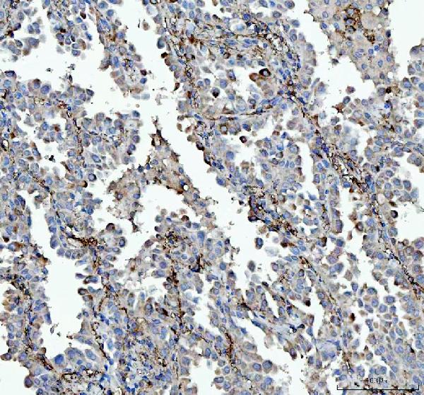 Figure 2. IHC analysis of VPAC2/VIPR2 using anti-VPAC2/VIPR2 antibody (A03768-1). VPAC2/VIPR2 was detected in a paraffin-embedded section of human lung cancer tissue. Heat mediated antigen retrieval was performed in EDTA buffer (pH 8.0, epitope retrieval solution). The tissue section was blocked with 10% goat serum. The tissue section was then incubated with 2 microg/ml rabbit anti-VPAC2/VIPR2 Antibody (A03768-1) overnight at 4°C. Peroxidase Conjugated Goat Anti-rabbit IgG was used as secondary antibody and incubated for 30 minutes at 37°C. The tissue section was developed using HRP Conjugated Rabbit IgG Super Vision Assay Kit (Catalog # SV0002) with DAB as the chromogen. Figure 2. IHC analysis of VPAC2/VIPR2 using anti-VPAC2/VIPR2 antibody (A03768-1). VPAC2/VIPR2 was detected in a paraffin-embedded section of human lung cancer tissue. Heat mediated antigen retrieval was performed in EDTA buffer (pH 8.0, epitope retrieval solution). The tissue section was blocked with 10% goat serum. The tissue section was then incubated with 2 microg/ml rabbit anti-VPAC2/VIPR2 Antibody (A03768-1) overnight at 4°C. Peroxidase Conjugated Goat Anti-rabbit IgG was used as secondary antibody and incubated for 30 minutes at 37°C. The tissue section was developed using HRP Conjugated Rabbit IgG Super Vision Assay Kit (Catalog # SV0002) with DAB as the chromogen.