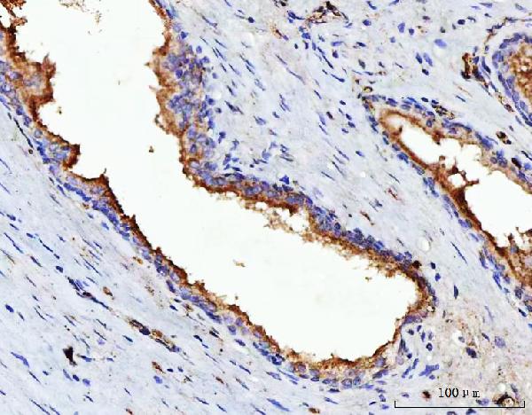 Figure 3. IHC analysis of VPAC2/VIPR2 using anti-VPAC2/VIPR2 antibody (A03768-1). VPAC2/VIPR2 was detected in a paraffin-embedded section of human prostate cancer tissue. Heat mediated antigen retrieval was performed in EDTA buffer (pH 8.0, epitope retrieval solution). The tissue section was blocked with 10% goat serum. The tissue section was then incubated with 2 microg/ml rabbit anti-VPAC2/VIPR2 Antibody (A03768-1) overnight at 4°C. Peroxidase Conjugated Goat Anti-rabbit IgG was used as secondary antibody and incubated for 30 minutes at 37°C. The tissue section was developed using HRP Conjugated Rabbit IgG Super Vision Assay Kit (Catalog # SV0002) with DAB as the chromogen. Figure 3. IHC analysis of VPAC2/VIPR2 using anti-VPAC2/VIPR2 antibody (A03768-1). VPAC2/VIPR2 was detected in a paraffin-embedded section of human prostate cancer tissue. Heat mediated antigen retrieval was performed in EDTA buffer (pH 8.0, epitope retrieval solution). The tissue section was blocked with 10% goat serum. The tissue section was then incubated with 2 microg/ml rabbit anti-VPAC2/VIPR2 Antibody (A03768-1) overnight at 4°C. Peroxidase Conjugated Goat Anti-rabbit IgG was used as secondary antibody and incubated for 30 minutes at 37°C. The tissue section was developed using HRP Conjugated Rabbit IgG Super Vision Assay Kit (Catalog # SV0002) with DAB as the chromogen.