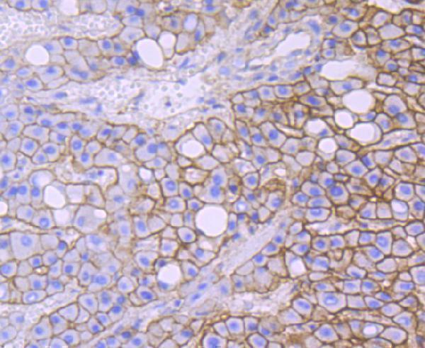 Immunohistochemical analysis of paraffin-embedded human liver cancer tissue using anti-Alpha Fodrin antibody