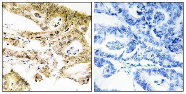 Immunohistochemistry analysis of paraffin-embedded human colon carcinoma tissue, using MED23 Antibody
