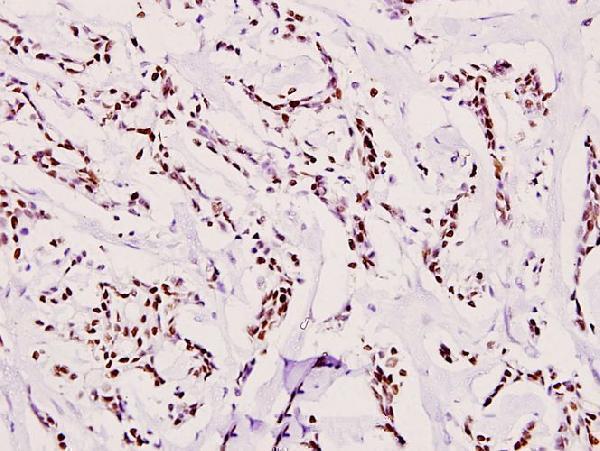 Immunohistochemistry (IHC) analyzes of ATRIP (D64) pAb in paraffin-embedded human breast carcinoma tissue at 1:100