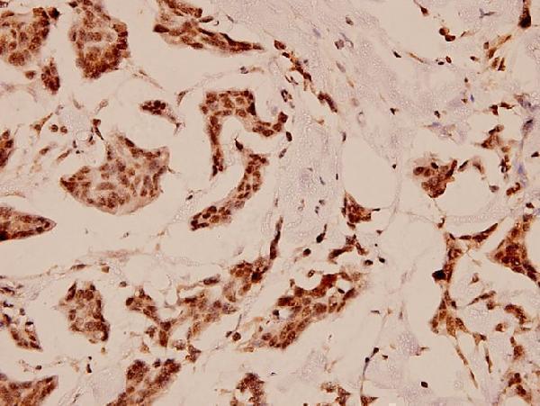 Immunohistochemistry (IHC) analyzes of C/EBP-ε (K70) pAb in paraffin-embedded human breast carcinoma tissue at 1:100