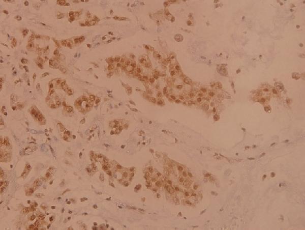 Immunohistochemistry (IHC) analyzes of TXNRD2 (S501) pAb in paraffin-embedded human breast carcinoma tissue at 1:100