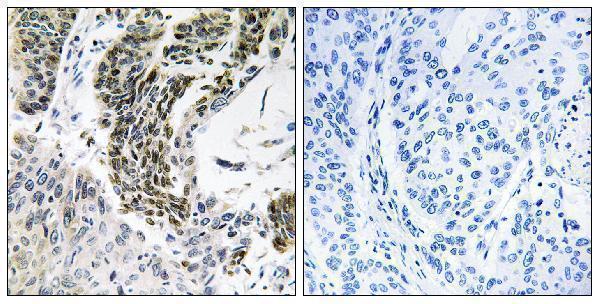 Immunohistochemistry analysis of paraffin-embedded human lung carcinoma tissue, using RREB1 Antibody