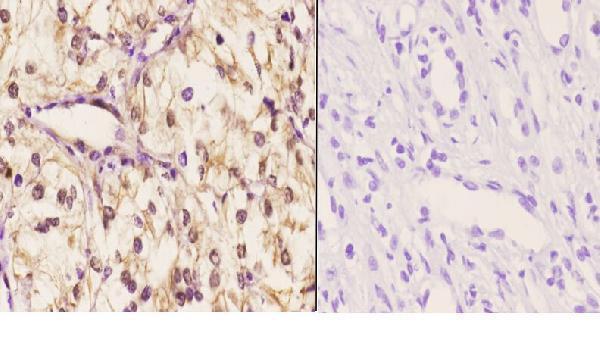 Immunohistochemistry (IHC) analyzes of 14-3-3 θ (W228) pAb in paraffin-embedded human kidney carcinoma tissue at 1:50