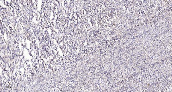Immunohistochemical analysis of paraffin-embedded human Colon cancer
