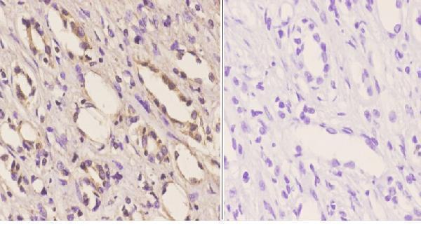 Immunohistochemistry (IHC) analyzes of PKA IIα reg (P68) pAb in paraffin-embedded human kidney carcinoma tissue at 1:50
