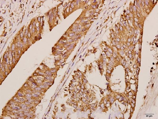 Immunohistochemistry (IHC) analyzes of GRK1 (A17) pAb in paraffin-embedded human colorectal carcinoma tissue at 1:50