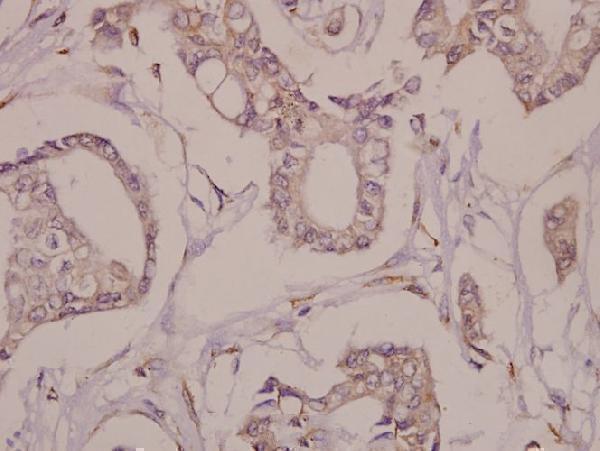 Immunohistochemistry (IHC) analyzes of Fra-1 (D134) pAb in paraffin-embedded human breast carcinoma tissue at 1:50