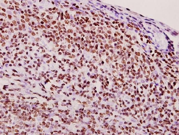 Immunohistochemistry (IHC) analyzes of hnRNP Q (E268) pAb in paraffin-embedded human tonsil carcinoma tissue at 1:50