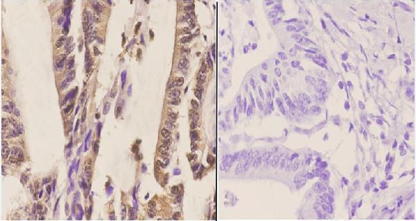 Immunohistochemistry (IHC) analyzes of SYT (A7) pAb in paraffin-embedded human colon carcinoma tissue at 1:50