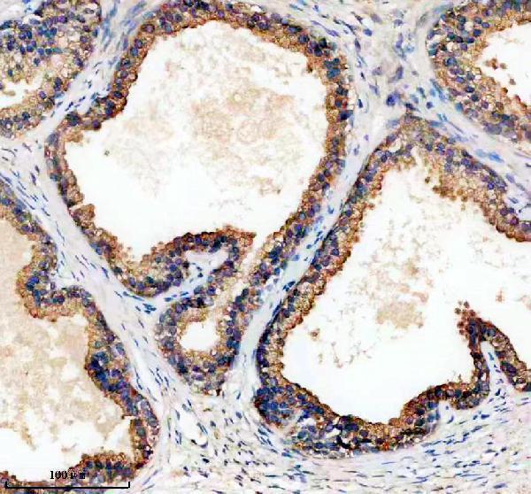 IHC analysis of TPD52 using anti-TPD52 antibody (A03949-2)