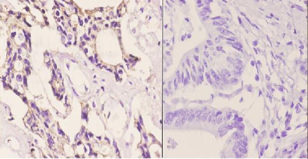 Immunohistochemistry (IHC) analyzes of CAF-1 p60 (W93) pAb in paraffin-embedded human colon carcinoma tissue at 1:50