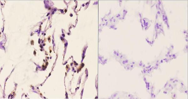 Immunohistochemistry (IHC) analyzes of CAF-1 p60 (W93) pAb in paraffin-embedded human lung carcinoma tissue at 1:50