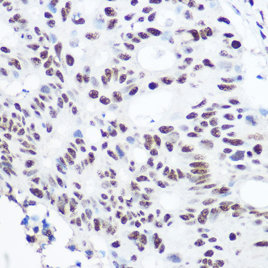 Immunohistochemistry of paraffin-embedded human colon carcinoma using SART3 Rabbit pAb  at dilution of 1:100 