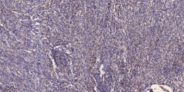 Immunohistochemical analysis of paraffin-embedded human Colon cancer