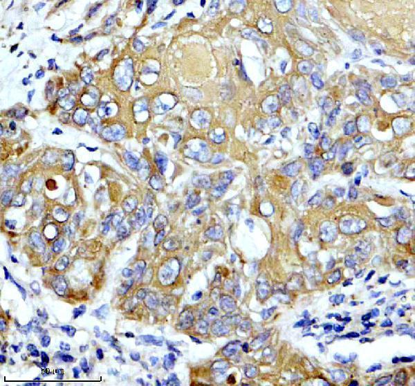 IHC analysis of Cytokeratin 6A/KRT6A using anti-Cytokeratin 6A/KRT6A antibody (A04012-2)
