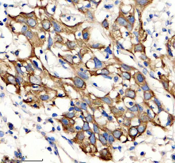IHC analysis of Cytokeratin 6A/KRT6A using anti-Cytokeratin 6A/KRT6A antibody (A04012-2)