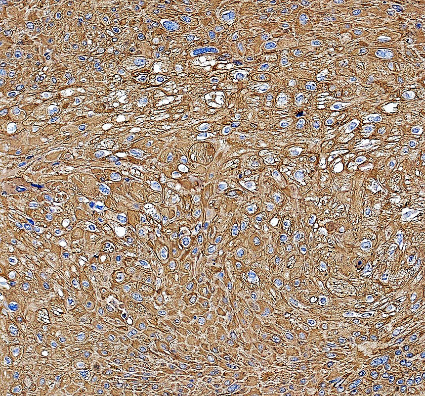 IHC analysis of KRT6A/B/C using anti-KRT6A/B/C antibody (A04012-3)
