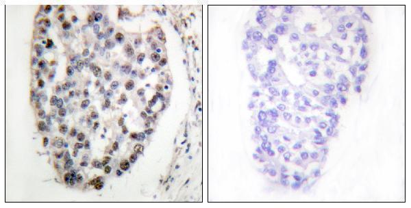 Immunohistochemistry analysis of paraffin-embedded human breast carcinoma tissue, using MYF5 Antibody