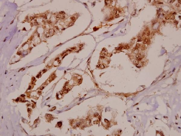 Immunohistochemistry (IHC) analyzes of BRD3 (F645) pAb in paraffin-embedded human breast carcinoma tissue at 1:50