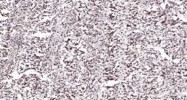 Immunohistochemical analysis of paraffin-embedded human Colon cancer