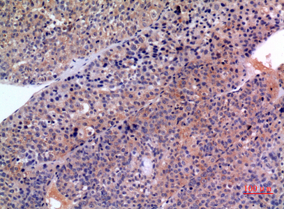 Immunohistochemical analysis of paraffin-embedded human-liver-cancer, antibody was diluted at 1:100