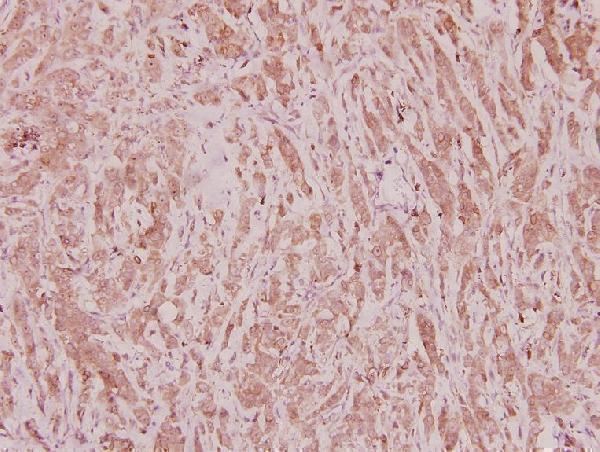 Immunohistochemistry (IHC) analyzes of C/EBP ζ (D24) pAb in paraffin-embedded human breast carcinoma tissue at 1:100