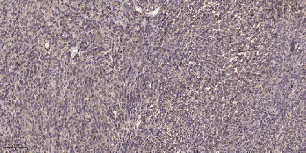 Immunohistochemical analysis of paraffin-embedded human Colon cancer