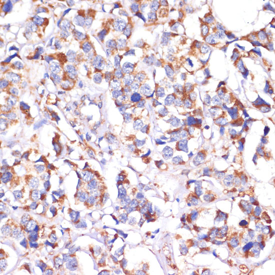 Immunohistochemistry of paraffin-embedded human breast cancer using STOML2 antibody  at dilution of 1:100 